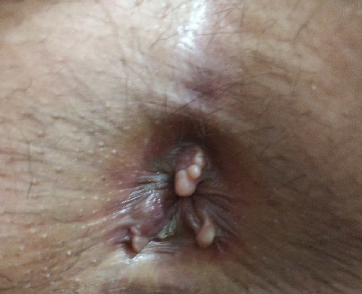 روده تحریک پذیر و خونریزی از مقعد