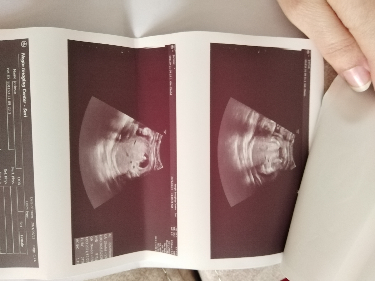 سونو هفته ی سی ام وزن کم جنین