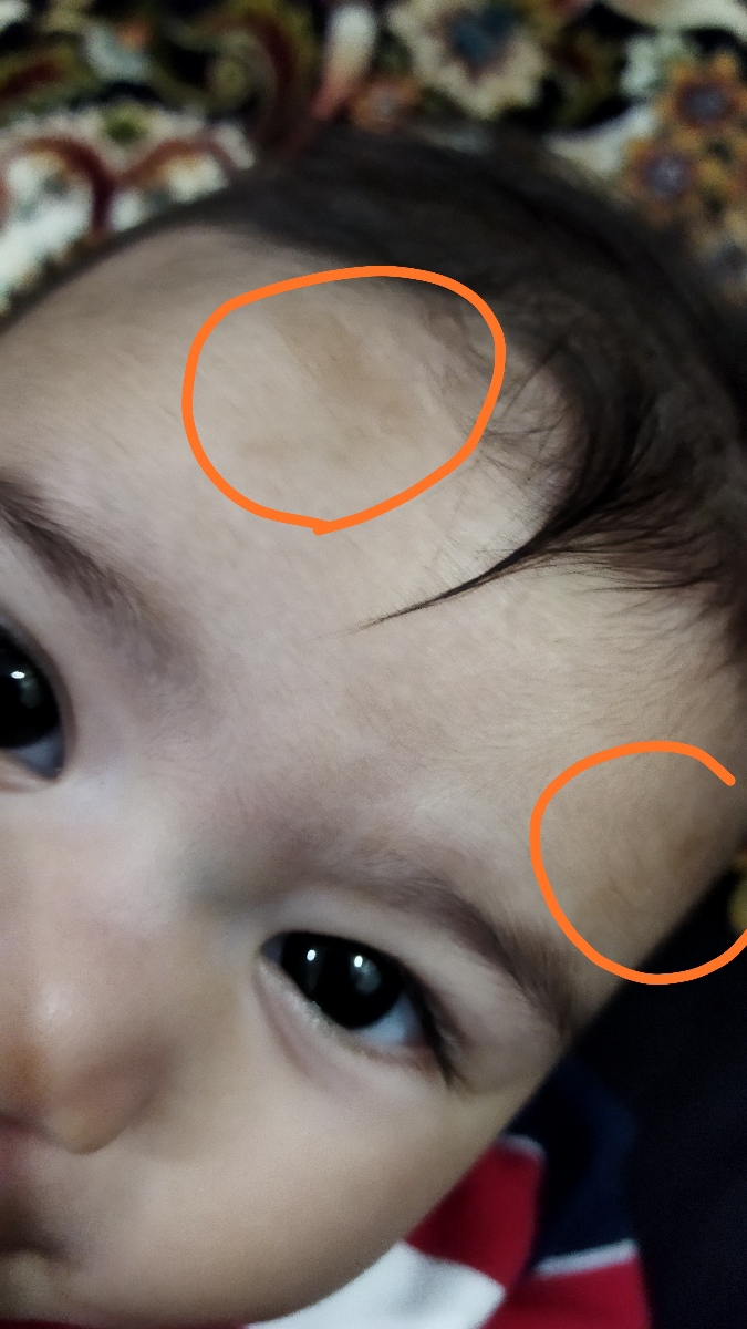 دکترجان این لکه روی صورت پسرم چیه؟