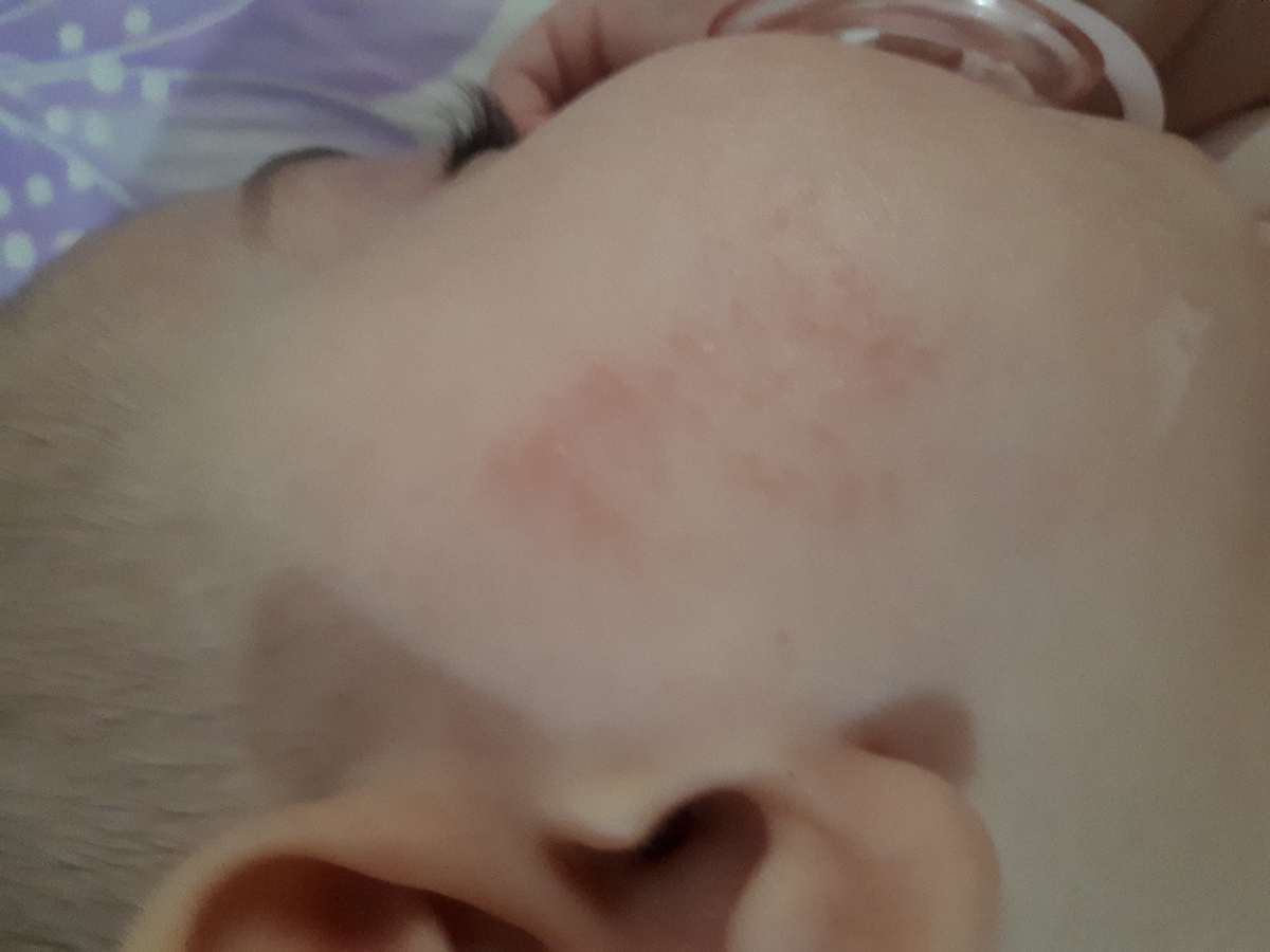 اگزمای پوستی صورت نوزاد