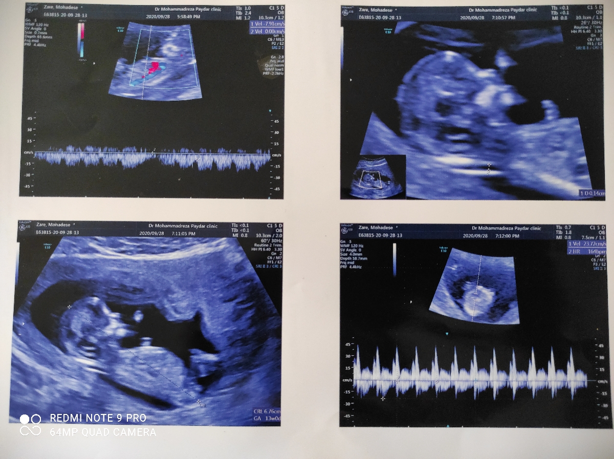 سلام.انذازه crl در سونوی ان تی و هفته بارداری