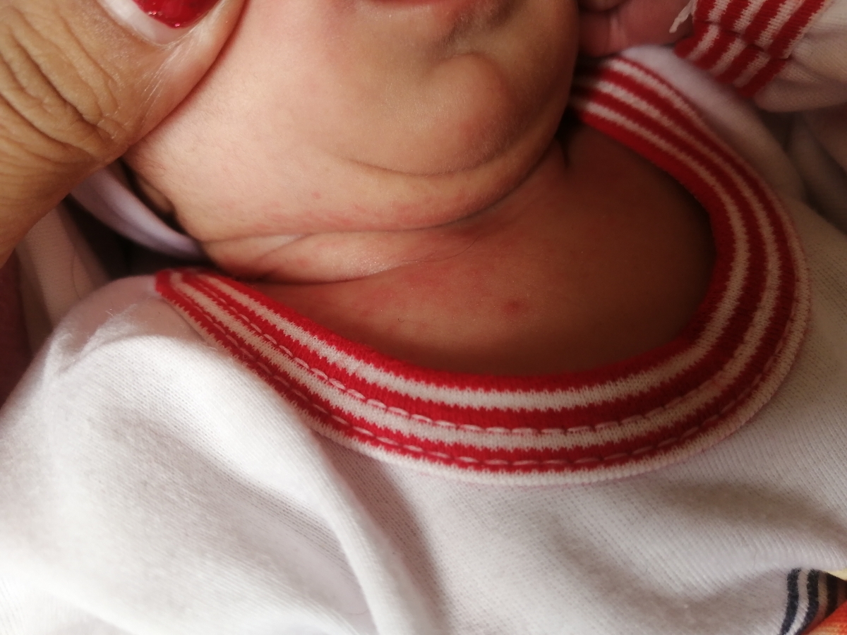 علت این دانه های روی پوست دخترم چیست