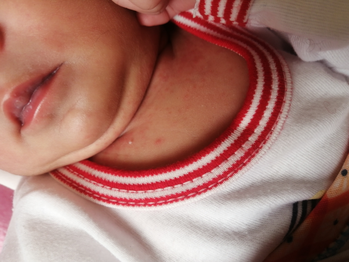 علت این دانه های روی پوست دخترم چیست