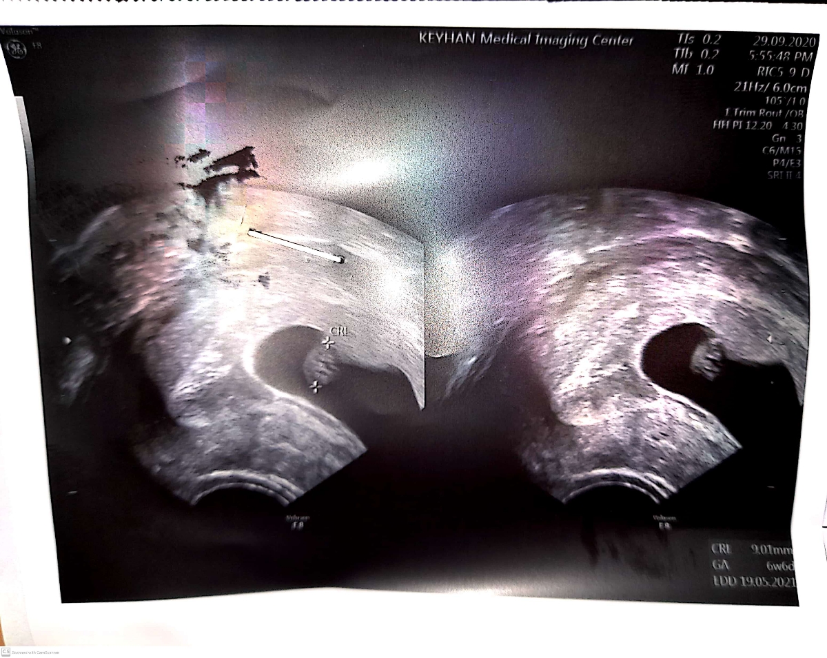 تفسیر سونو، واژینال، تشکیل قلب