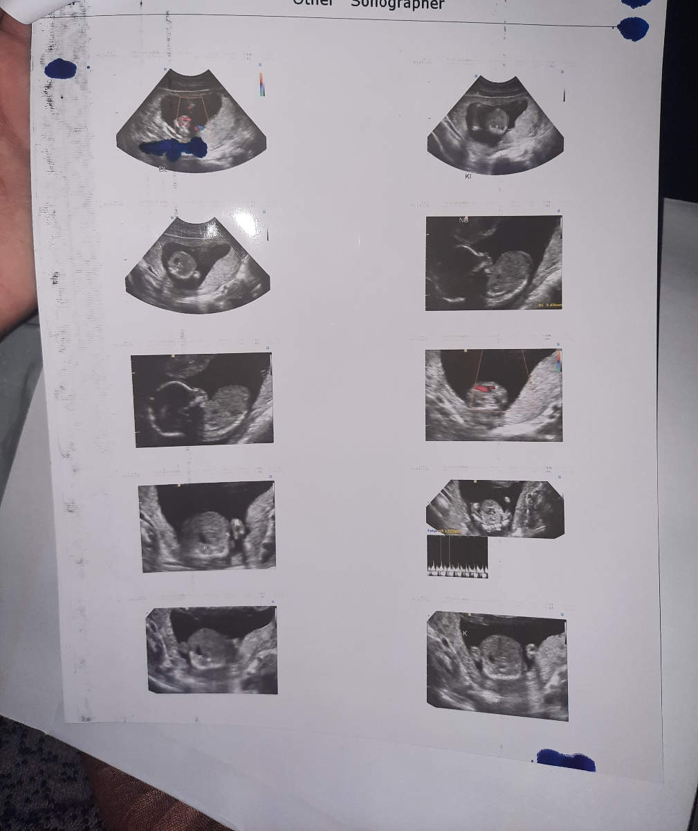 سونو آنومالی منو میبیند