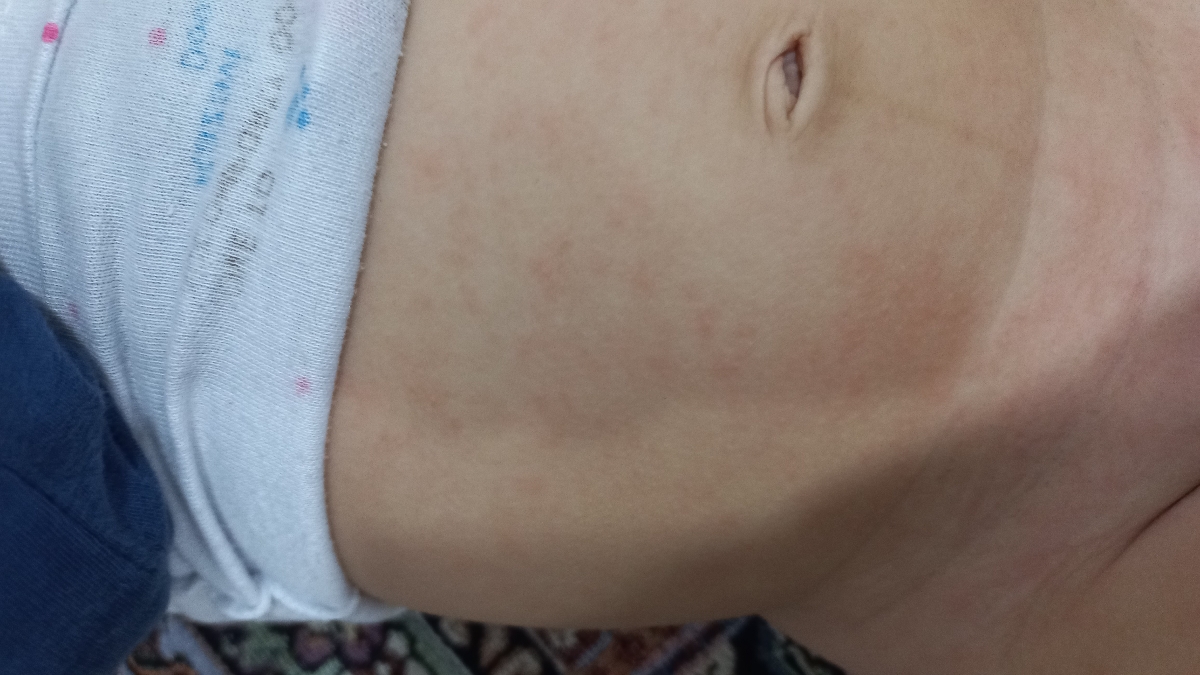 سلام پیشونی دخترم و بدنش اینجوری شده