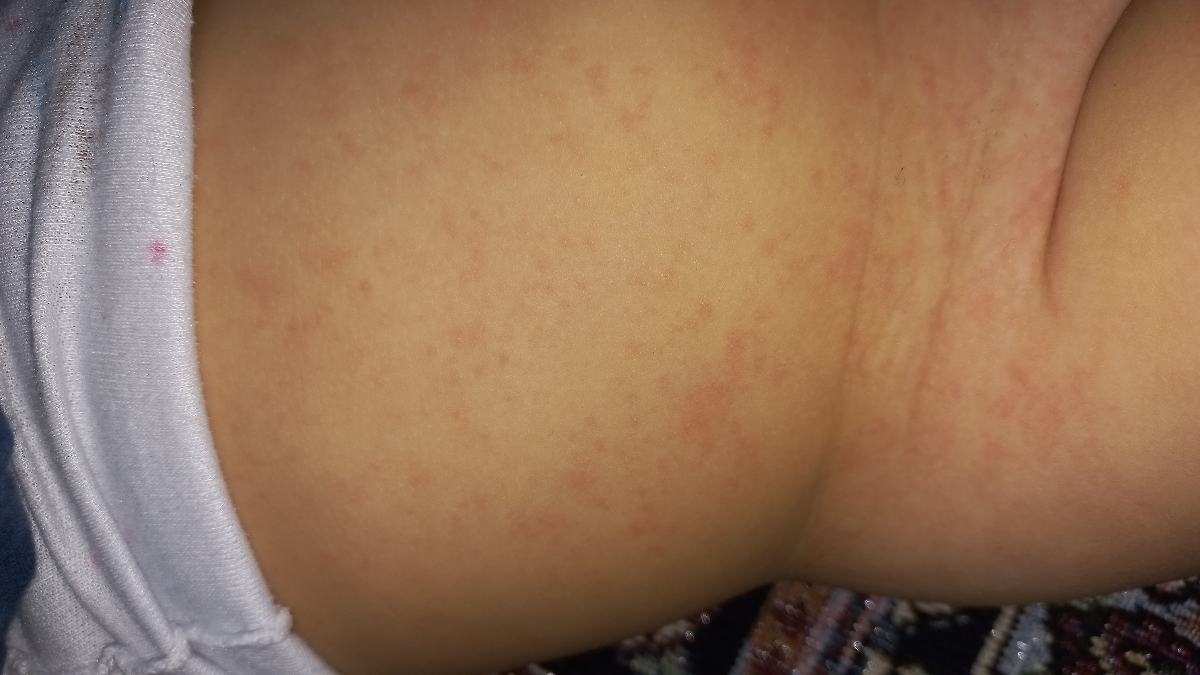 سلام پیشونی دخترم و بدنش اینجوری شده