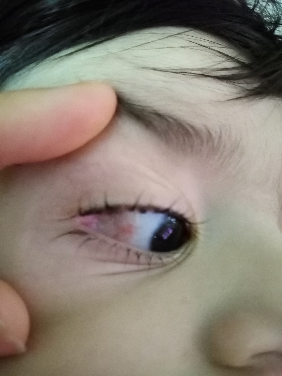 قرمزی گوشه چشم پسرم