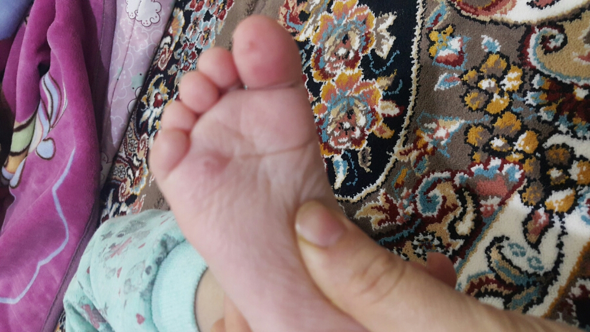 جوش های ابکی دختر دو ساله