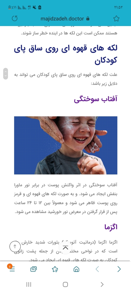 لک پشت ساق پای نوزاد لک پشت ساق پای نوزاد