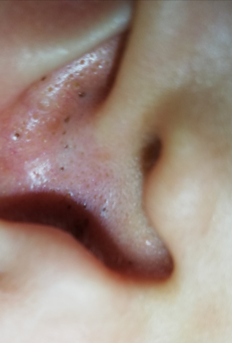 ⁦👂🏻⁩دلیل زدن جوش سر سیاه تو گوش بچه