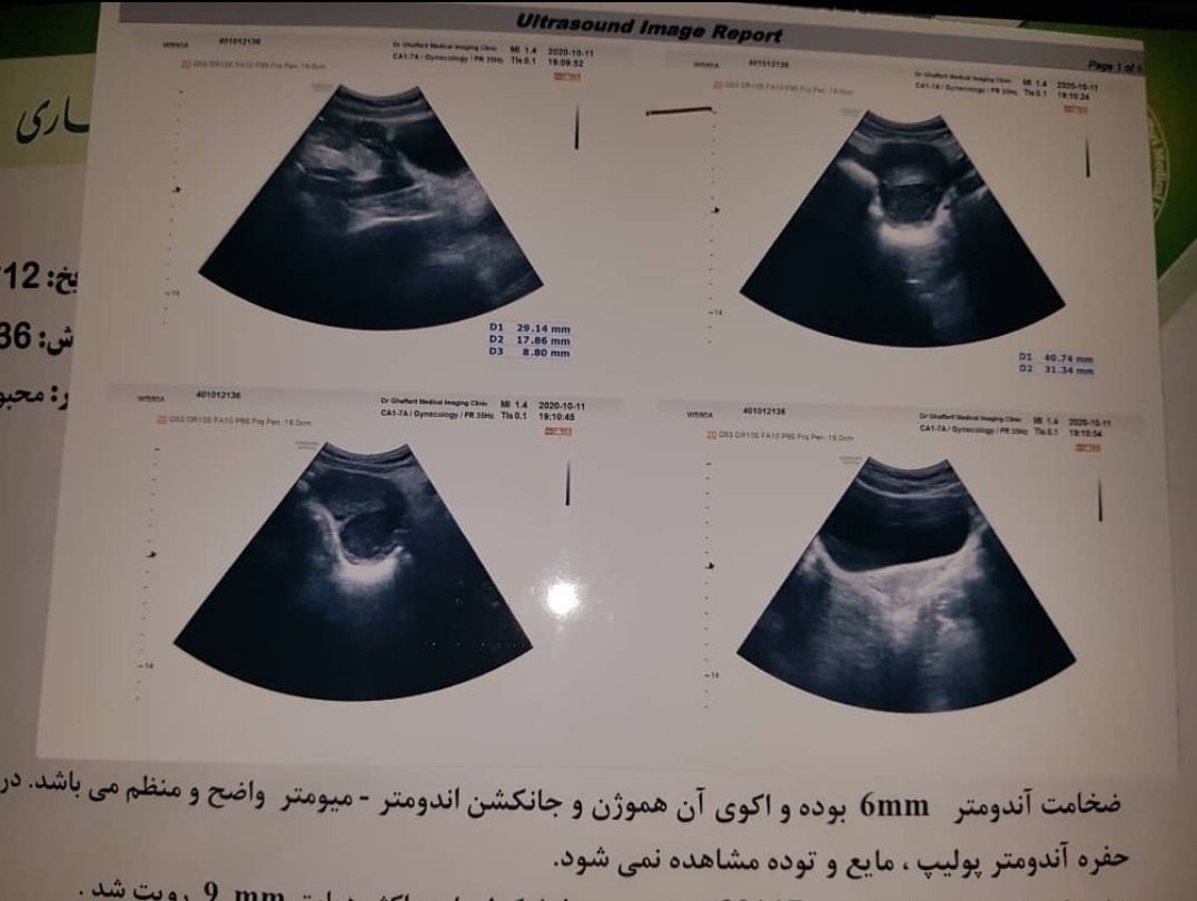 کیست و اقدام به بارداری