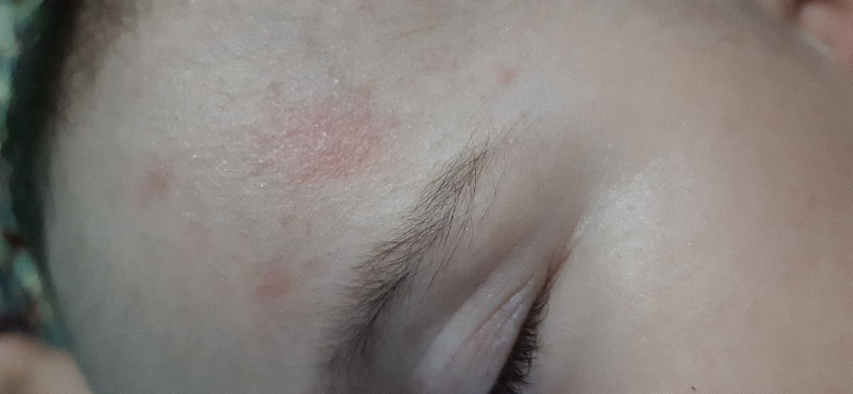 دونه های قرمز روی صورت نوزاد دونه های قرمز روی صورت نوزاد