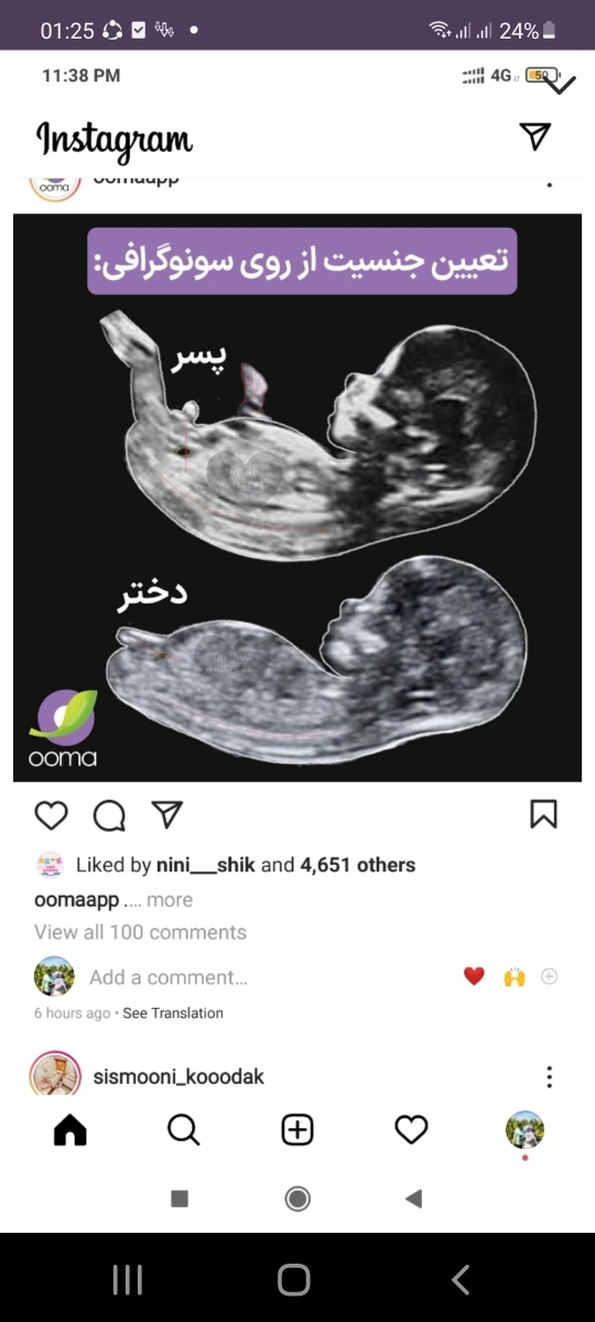 سونو ان تی و تشخیص جنسیت با شما دوستان سونو ان تی و تشخیص جنسیت با شما دوستان