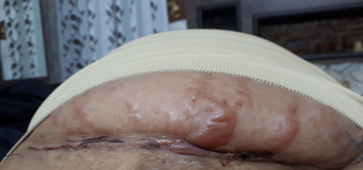 جواب سونو جای سزارین جواب سونو جای سزارین