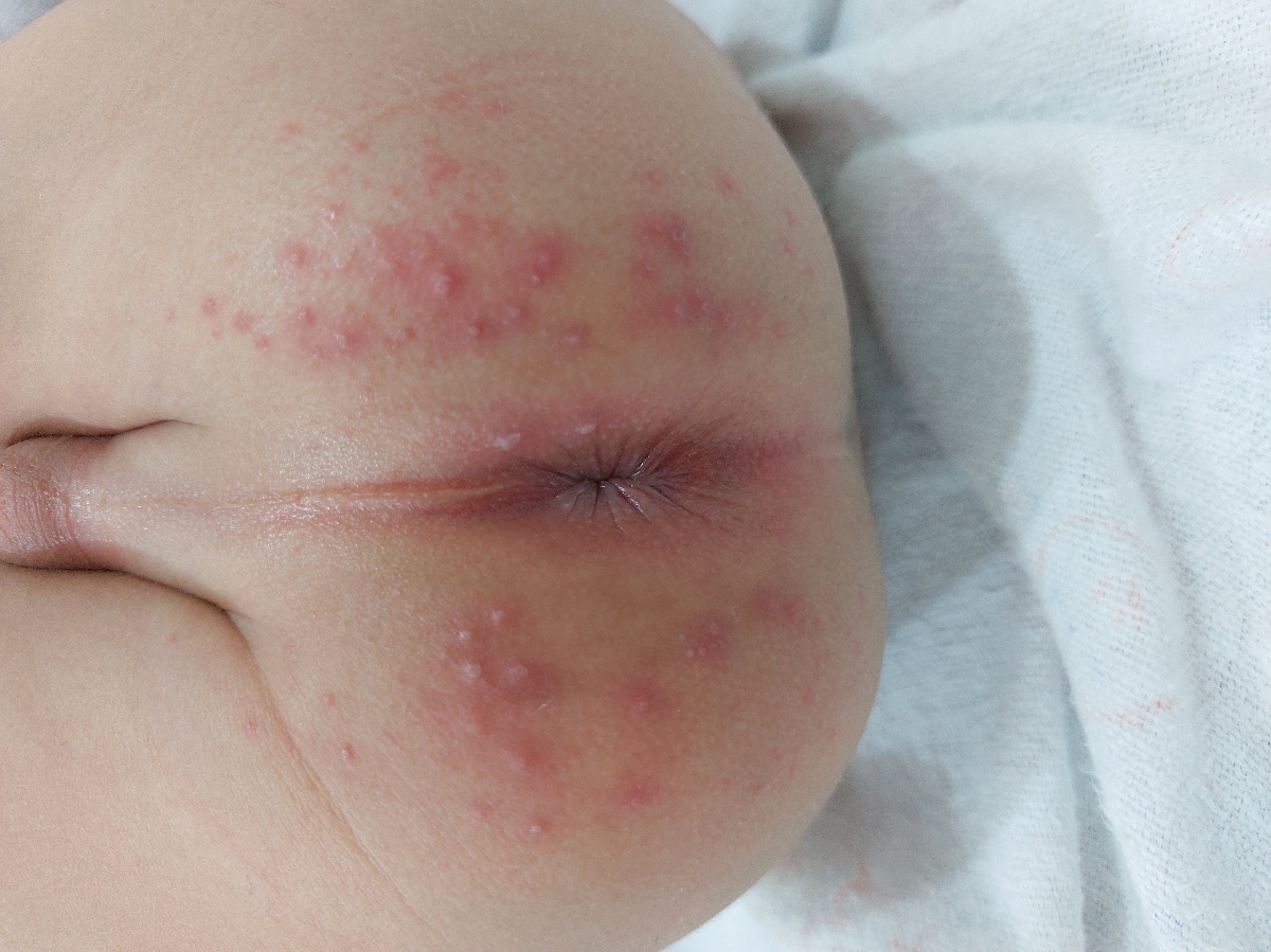 جوش روی باسن کودک 2 ساله جوش روی باسن کودک 2 ساله