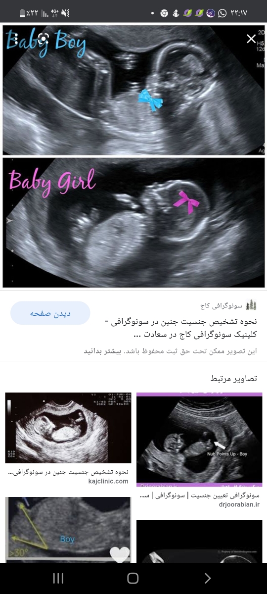 متخصصای تعیین جنسیت بیاین سونو ان تی رو ببنید حدس بزنیم باهم متخصصای تعیین جنسیت بیاین سونو ان تی رو ببنید حدس بزنیم باهم