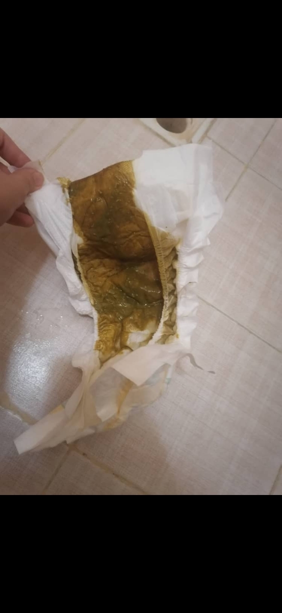 بی خوابی و اسهال نوزاد 42 روزه + عکس مدفوع