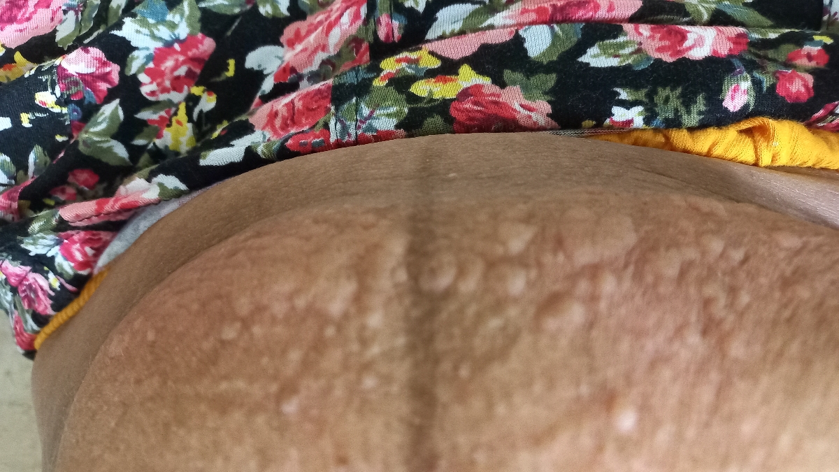 اینجوری تاول میزنه قرمز میشه و میخاره اینجوری تاول میزنه قرمز میشه و میخاره