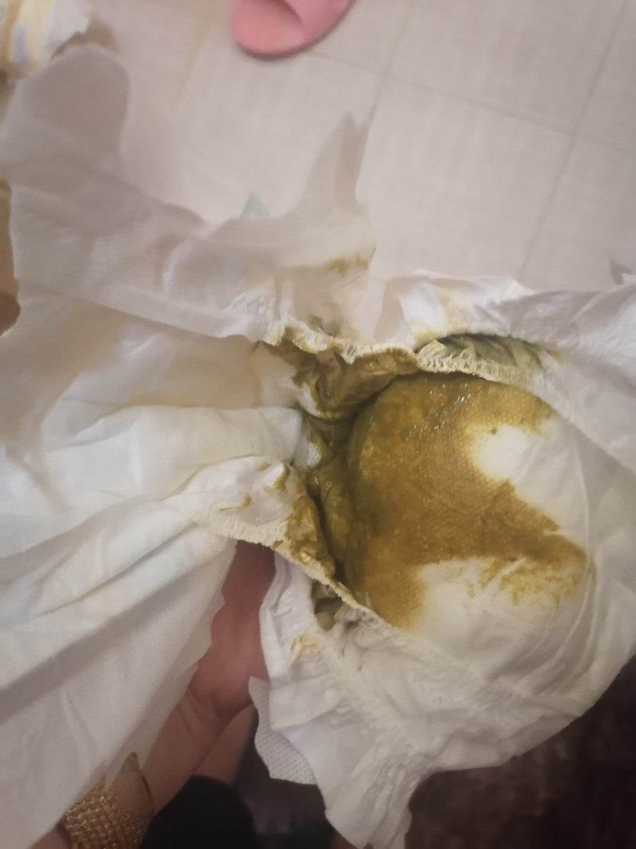 بی خوابی و اسهال نوزاد 42 روزه + عکس مدفوع