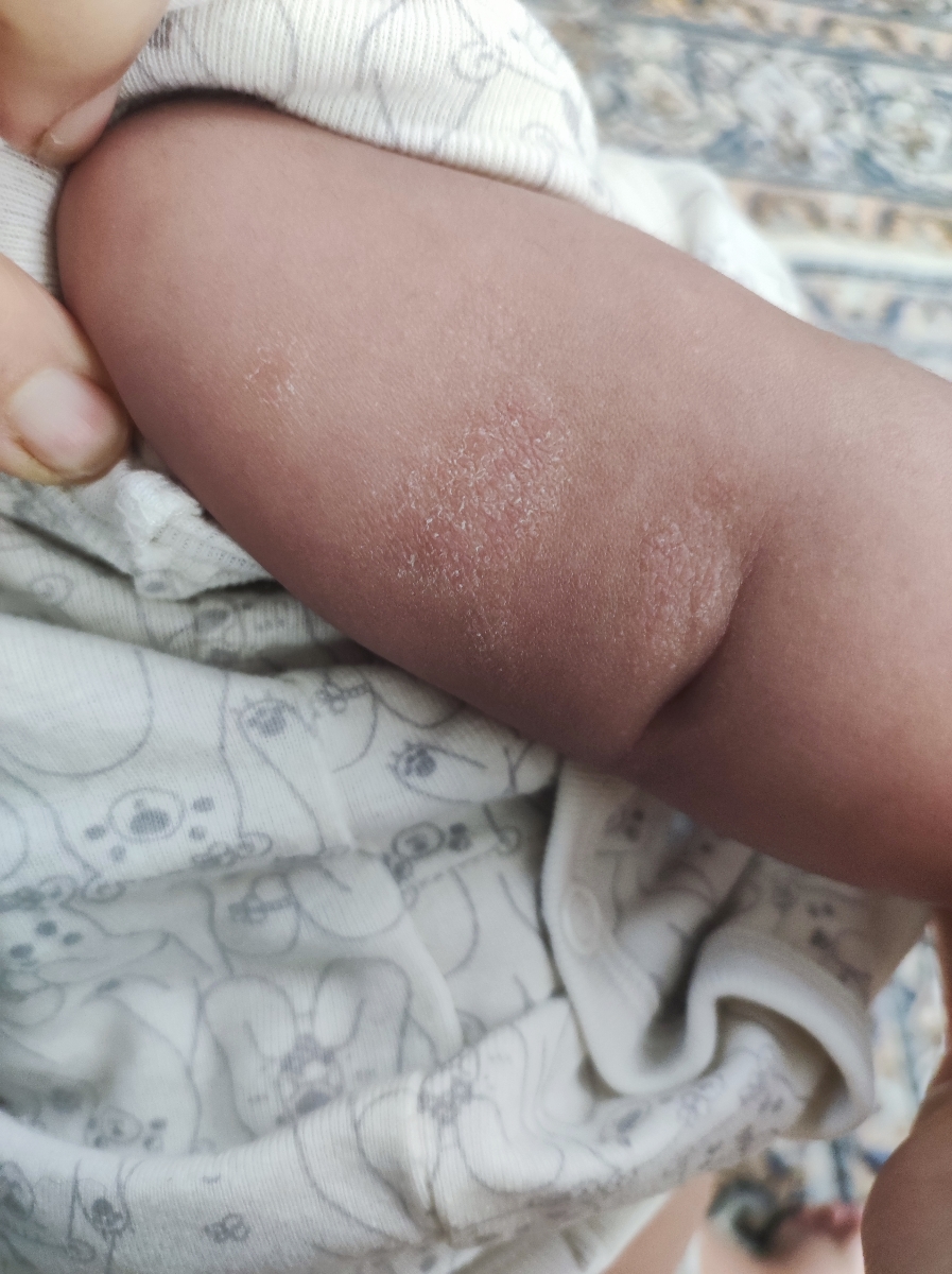 حساسیت پسرم و اگزمای بدن حساسیت پسرم و اگزمای بدن