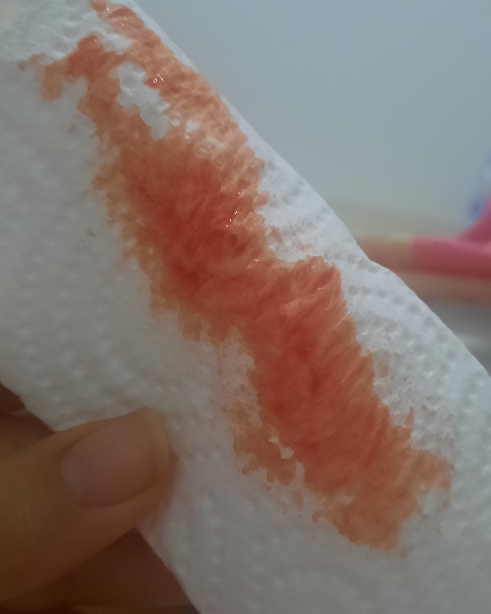 سرکلاژ دوبل و خون(مامانا عکس گذاشتم بدتون میاد نگاه نکنید لطفا)