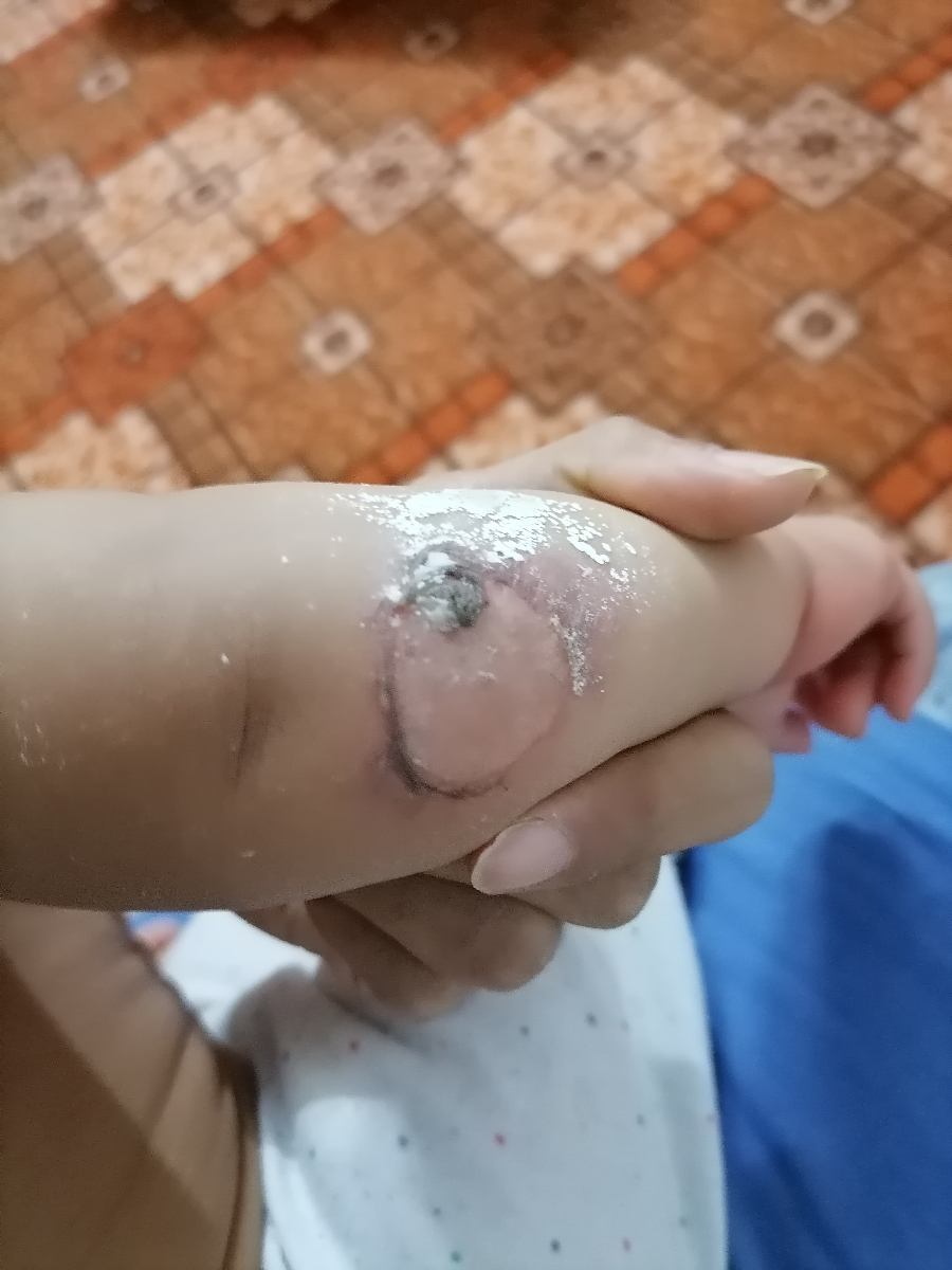 دست دخترم باابجوش سوخته چیکارش کنم دخترم هشت ماه دوازده روزشه دست دخترم باابجوش سوخته چیکارش کنم دخترم هشت ماه دوازده روزشه
