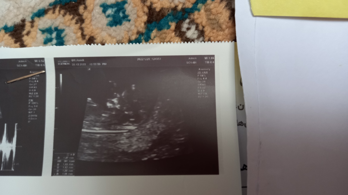 ❓❓تفسیر سونو ان تی و تعیین جنسیت ❓❓تفسیر سونو ان تی و تعیین جنسیت