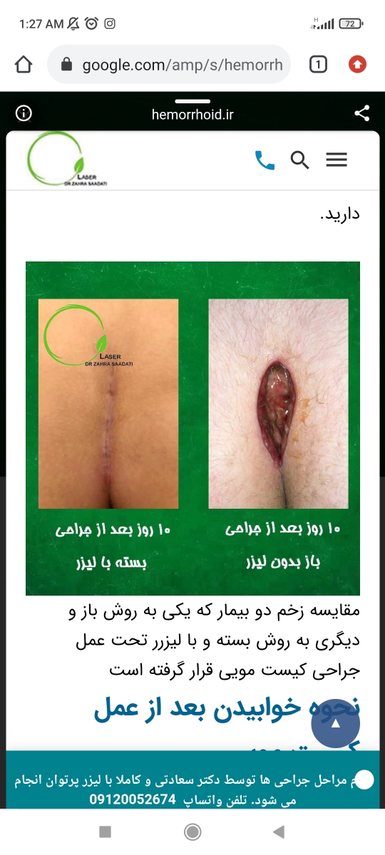 بریدن پا با شیشه «اورژانسی»