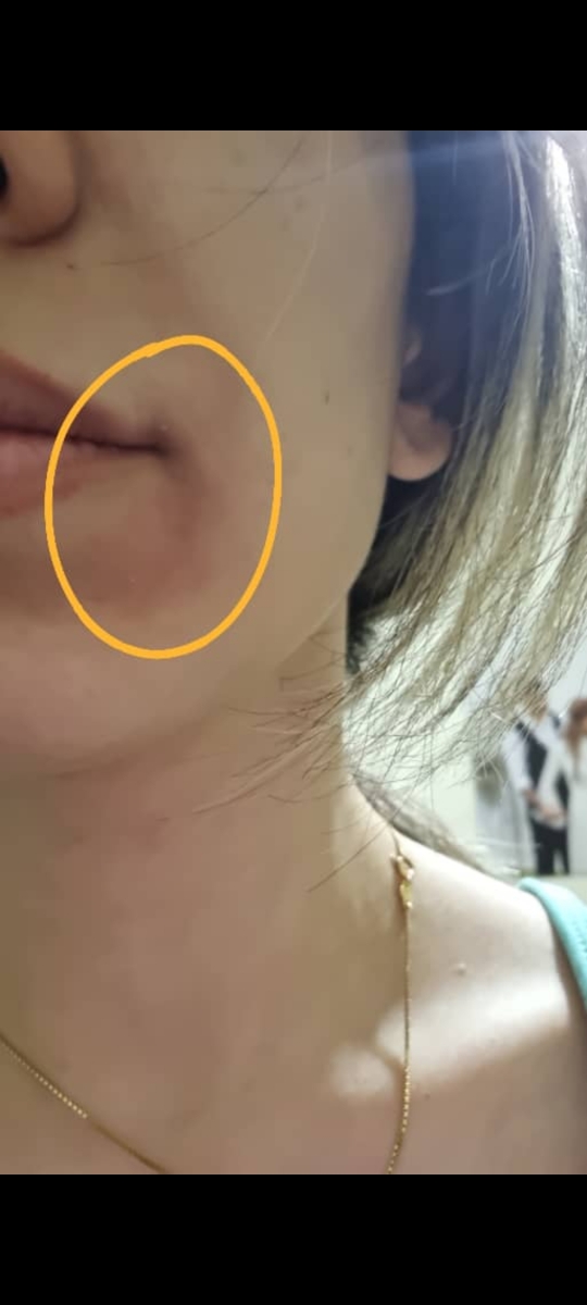 کهیر و اگزما روی صورت
