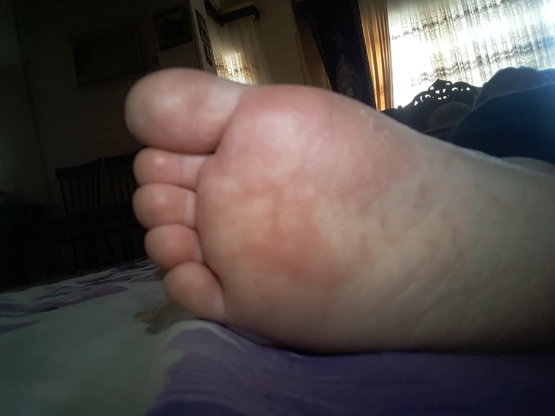 علت تغییرات پوستی پای کودک ۲ ساله