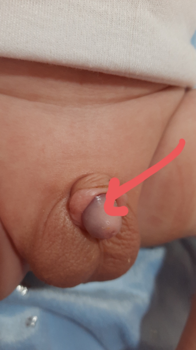 آلت تناسلی بچه ام انگاری کبود شده 😔😔😔😔