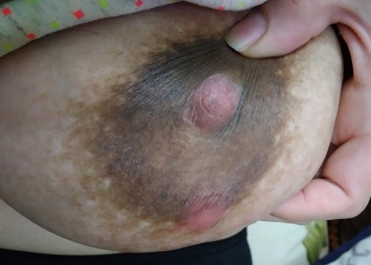 احساس حالت سوختگی روی پستان