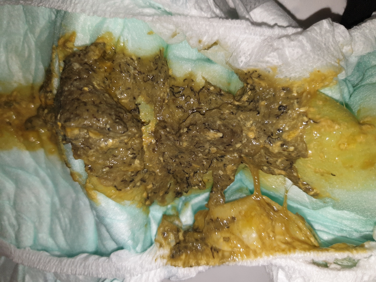 رگه های کوچک و سیاه در مدفوع( همراه عکس) رگه های کوچک و سیاه در مدفوع( همراه عکس)