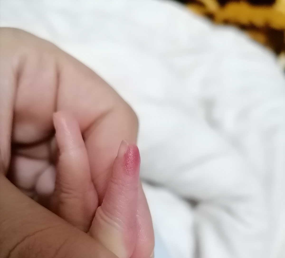 قرمز شدن انگشت نوزاد