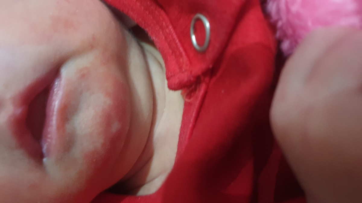 قرمز شدن چانه نوزاد ۳روزه قرمز شدن چانه نوزاد ۳روزه