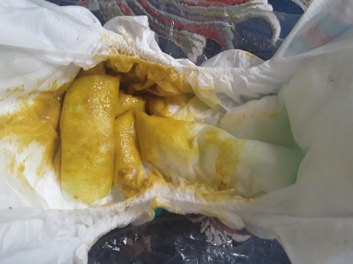 مدفوع ابکی نوزاد پسر