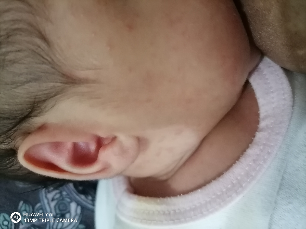 دونه های قرمز روی صورت نوزاد
