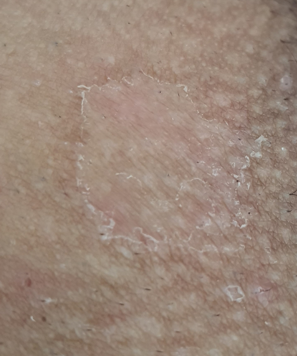 قارچ پوستی ( عکس)