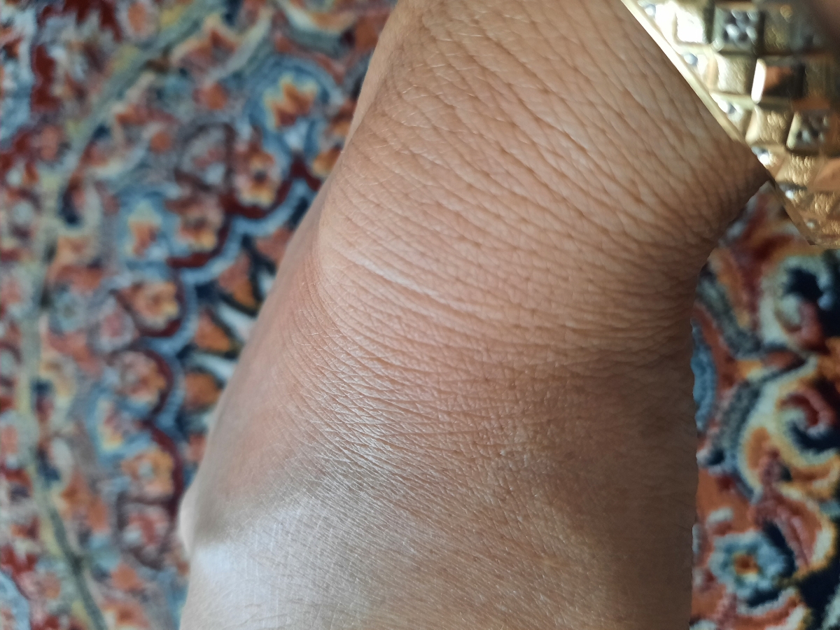 ورم مچ دست راست