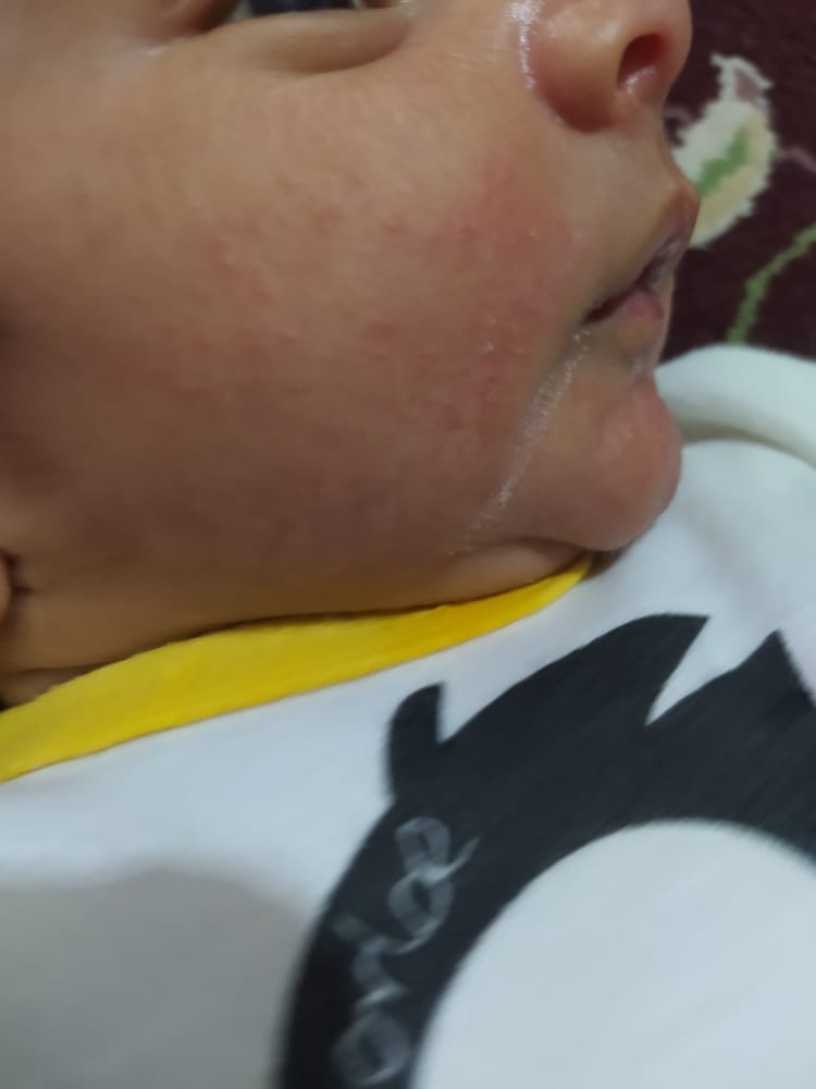 سلام خانم دکتر و دوستان عزیز صورت نوزادم دونه های قرمز زده سلام خانم دکتر و دوستان عزیز صورت نوزادم دونه های قرمز زده