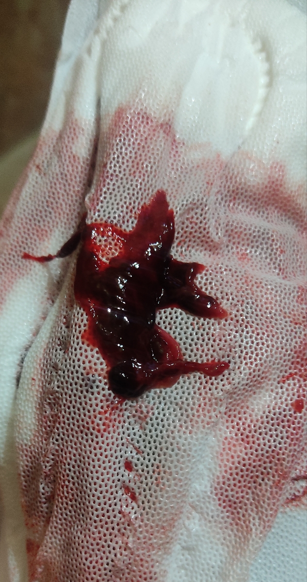 دفع بقایا بارداری+ عکس میزارم اگه بدتون میاد نیایید لطفا دفع بقایا بارداری+ عکس میزارم اگه بدتون میاد نیایید لطفا