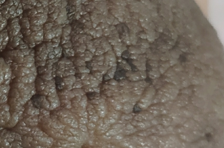 زگیل روی سینه در بارداری+عکس زگیل روی سینه در بارداری+عکس