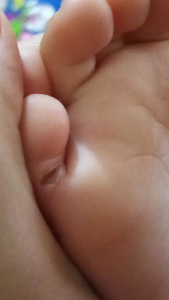 زخم انگشت کوچیکه پای پسرم