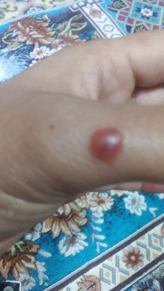 جوش ابکی چرکی