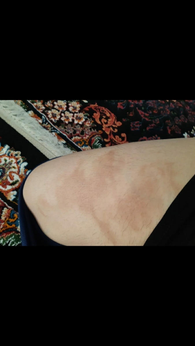 جای سوختگی روی پا