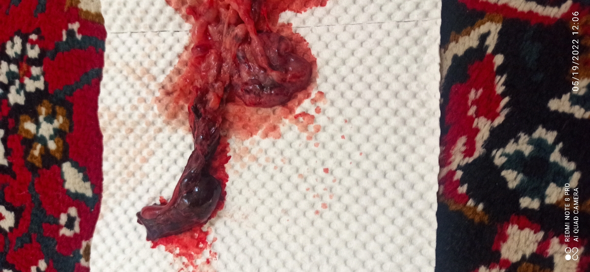 مراحل سقط شدن جنین