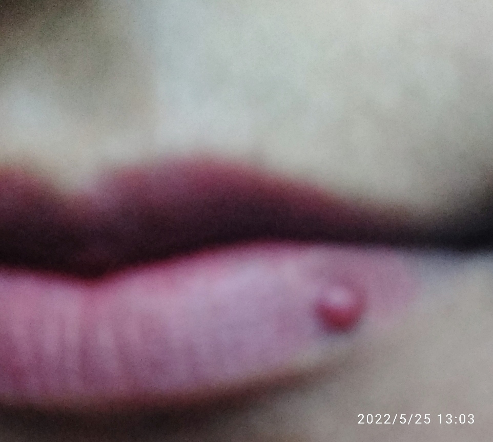 تبخال روی لب از چیه تبخال روی لب از چیه