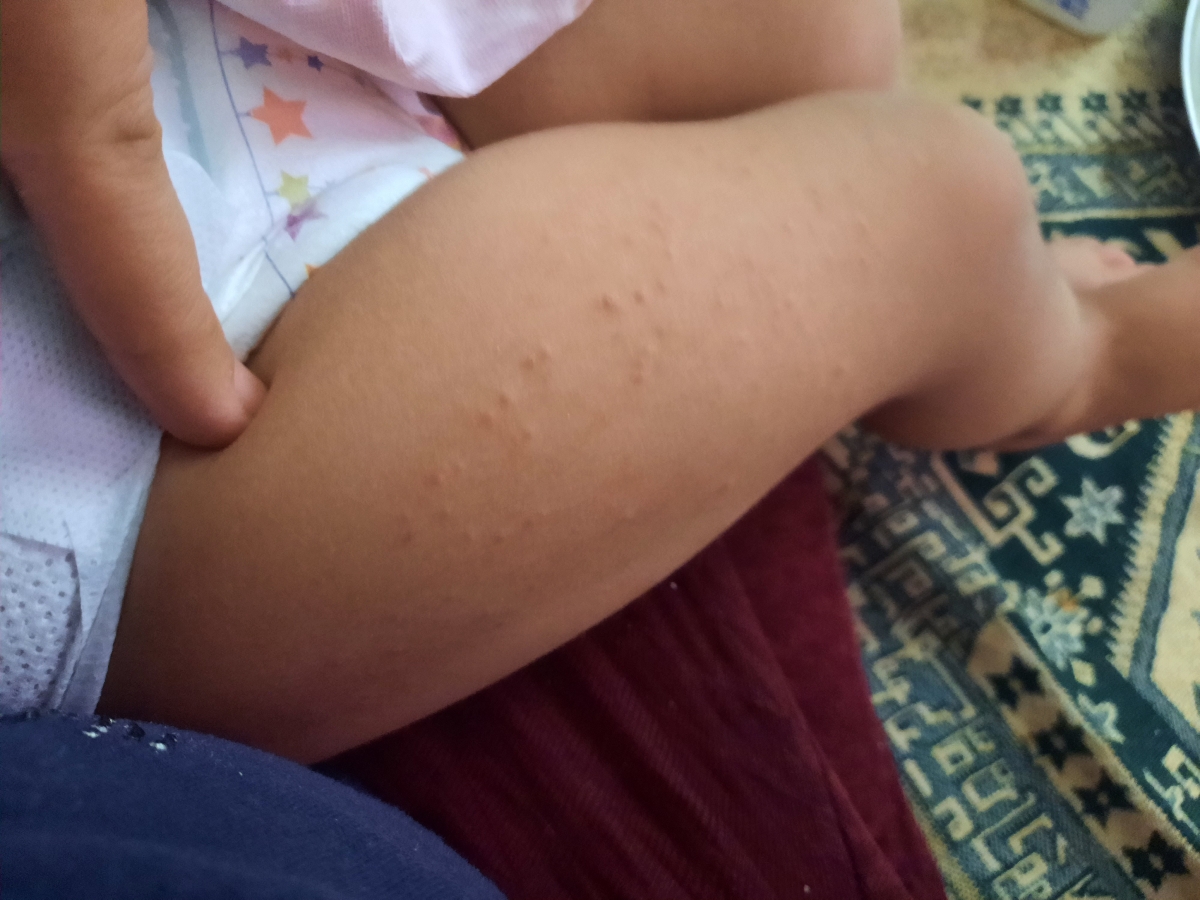 علت اگزمای پای کودک علت اگزمای پای کودک