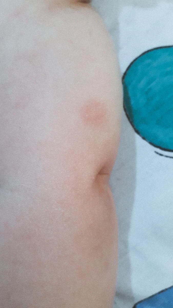 لکه قرمز پوستی نوزاد
